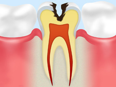 C2：象牙質の虫歯
