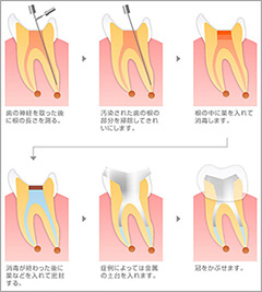 根管治療とは？