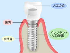 咬み心地も見た目も自然なのがインプラントの特長です