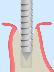 専用のドリルで顎の骨にインプラントを埋め込むための穴を開けます。