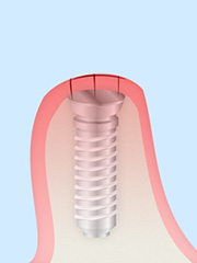 埋め込んだインプラントを歯肉で覆って縫合し、顎の骨とインプラントが安定するのを待ちます。