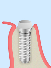 インプラントが安定したら、人工歯との接続部分となるアバットメントを装着します。
