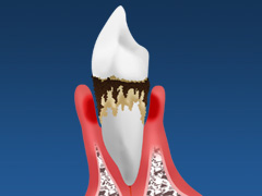 歯周病はとても身近で、とても怖い病気です