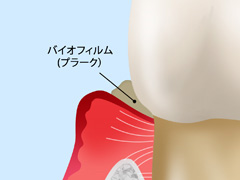 軽度の歯周病（歯肉炎）