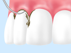 軽度の歯周病（歯肉炎）