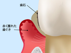 中等度歯周病（歯周炎）