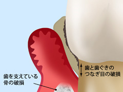 重度の歯周病（歯周炎）