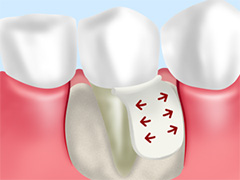 重度の歯周病（歯周炎）