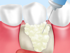 重度の歯周病（歯周炎）